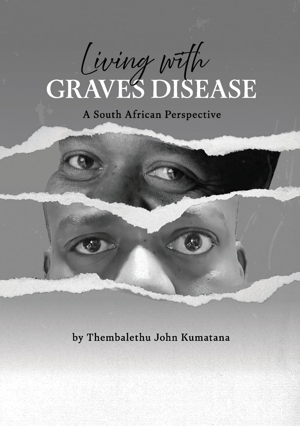 Living with Graves Disease: A South African Perspective