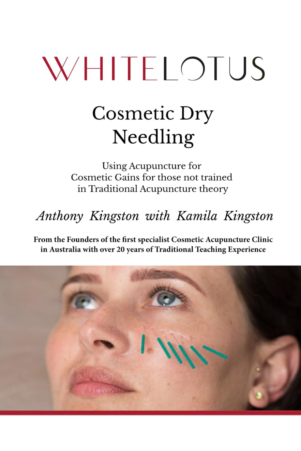 Cosmetic Dry Needling - Using Acupuncture for Cosmetic Gains for those not trained in Traditional Acupuncture theory