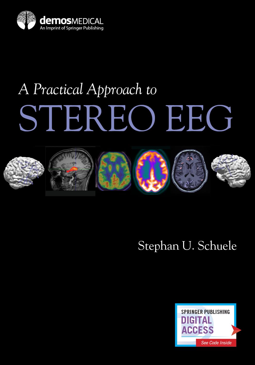 Un enfoque práctico de la EEG estéreo