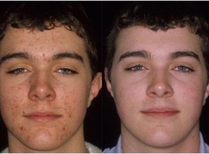 Acnetame Acne Pills - Suplemento vitamínico para el acné - 60 comprimidos – Image 4