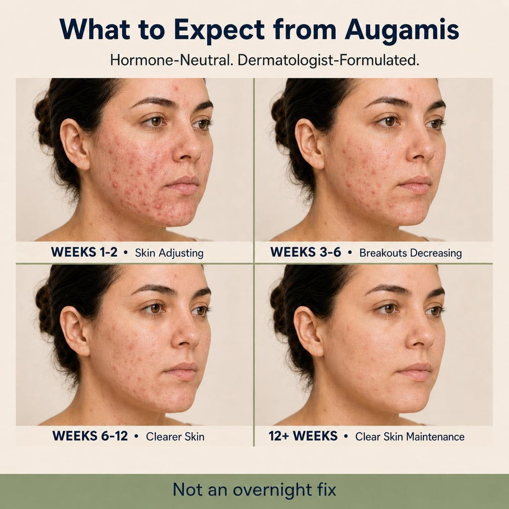 Augamis Tratamiento Hormonal para el Acné Femenino – Suplemento Libre de DIM para Piel Clara, Rostro y Cuerpo – 60 Cápsulas, 485 mg