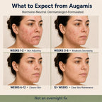 Augamis Tratamiento Hormonal para el Acné Femenino – Suplemento Libre de DIM para Piel Clara, Rostro y Cuerpo – 60 Cápsulas, 485 mg