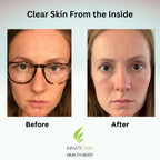 Clear Skin Acne Vitamin System | 20 Antioxidantes, Botánicos y Minerales | Cápsulas | 60 Unidades | Pack de 2