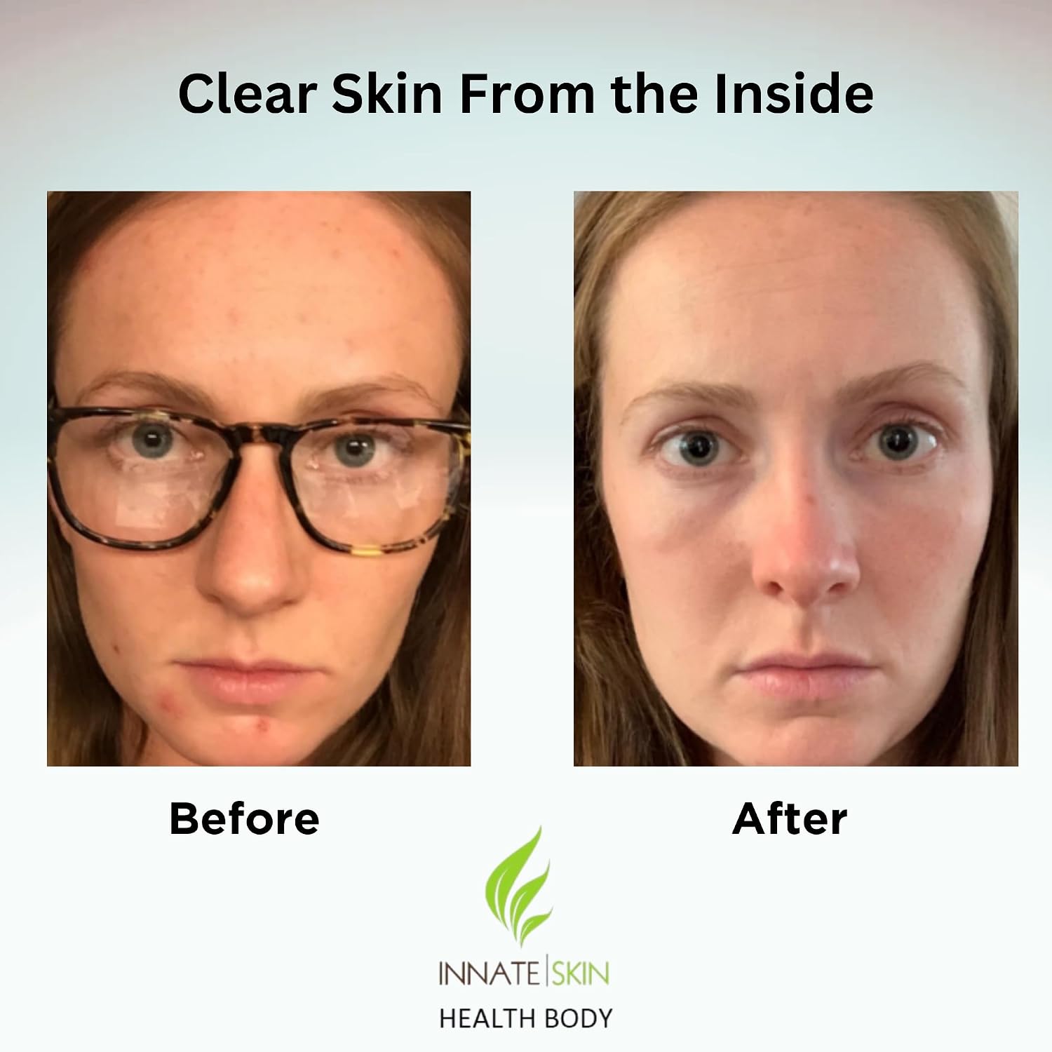 Clear Skin Acne Vitamin System | 20 Antioxidantes, Botánicos y Minerales | Cápsulas | 60 Unidades | Pack de 2