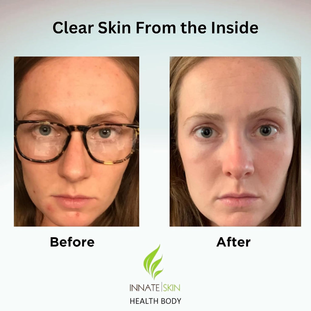 Clear Skin Acne Vitamin System | 20 Antioxidants and Minerals | 240 Capsules