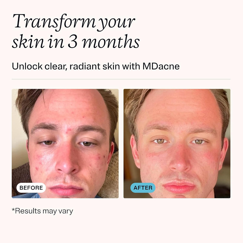 MDacne Vitaminas y Minerales para Piel Clara - 3 Paquetes (90 Cápsulas Veganas)
