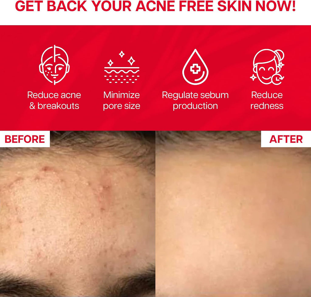 Clear It+ Suplemento para el Acné – Apoyo Hormonal y Quístico con 10 Mil Millones de UFC Probióticos, Zinc, Magnesio y Complejo Vitamínico B – Detox Cutáneo para una Piel Más Clara y Lisa (30 Sobres)