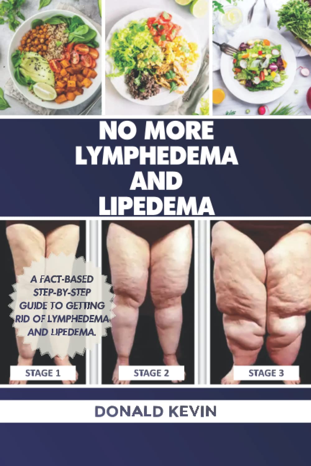 No Más Lymphedema y Lipedema: Una guía paso a paso basada en hechos para deshacerse del linfedema y el lipedema