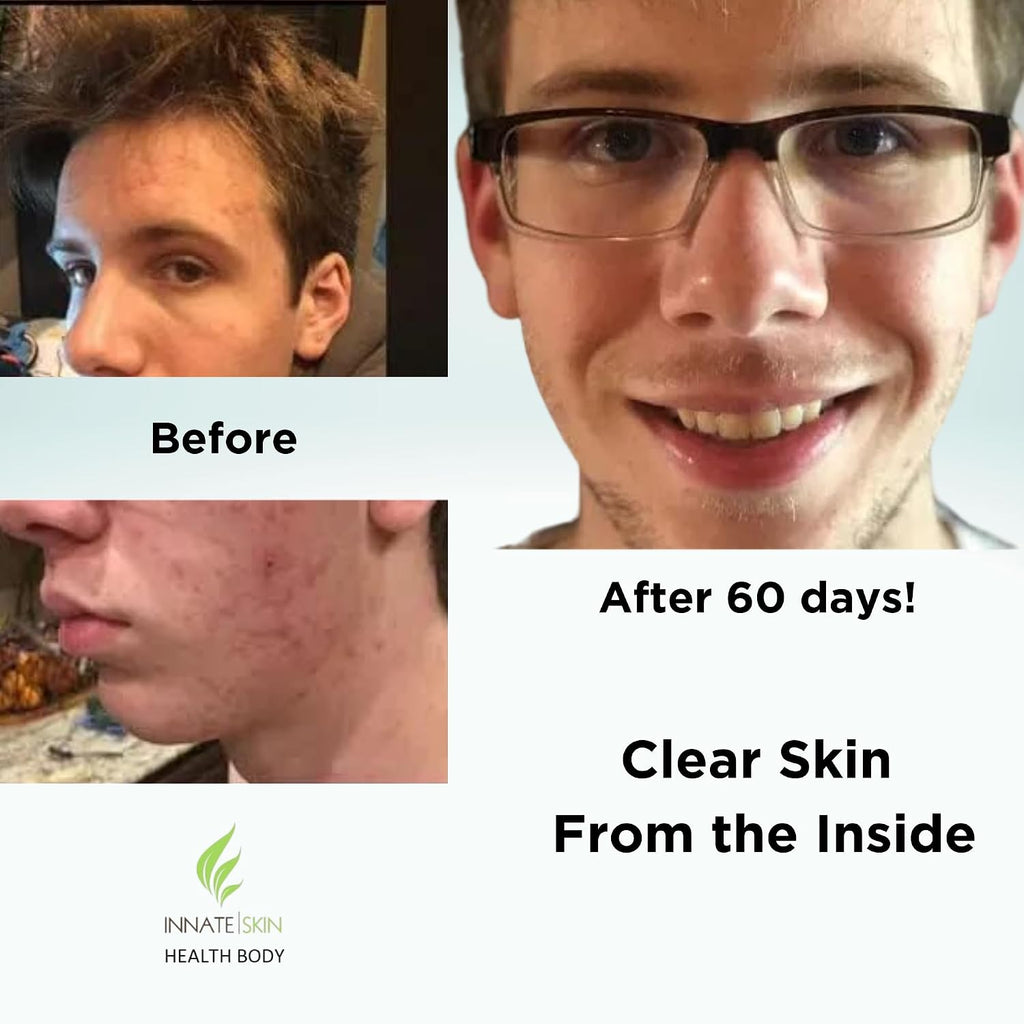 Clear Skin Acne Vitamin System | 20 Antioxidants and Minerals | 240 Capsules