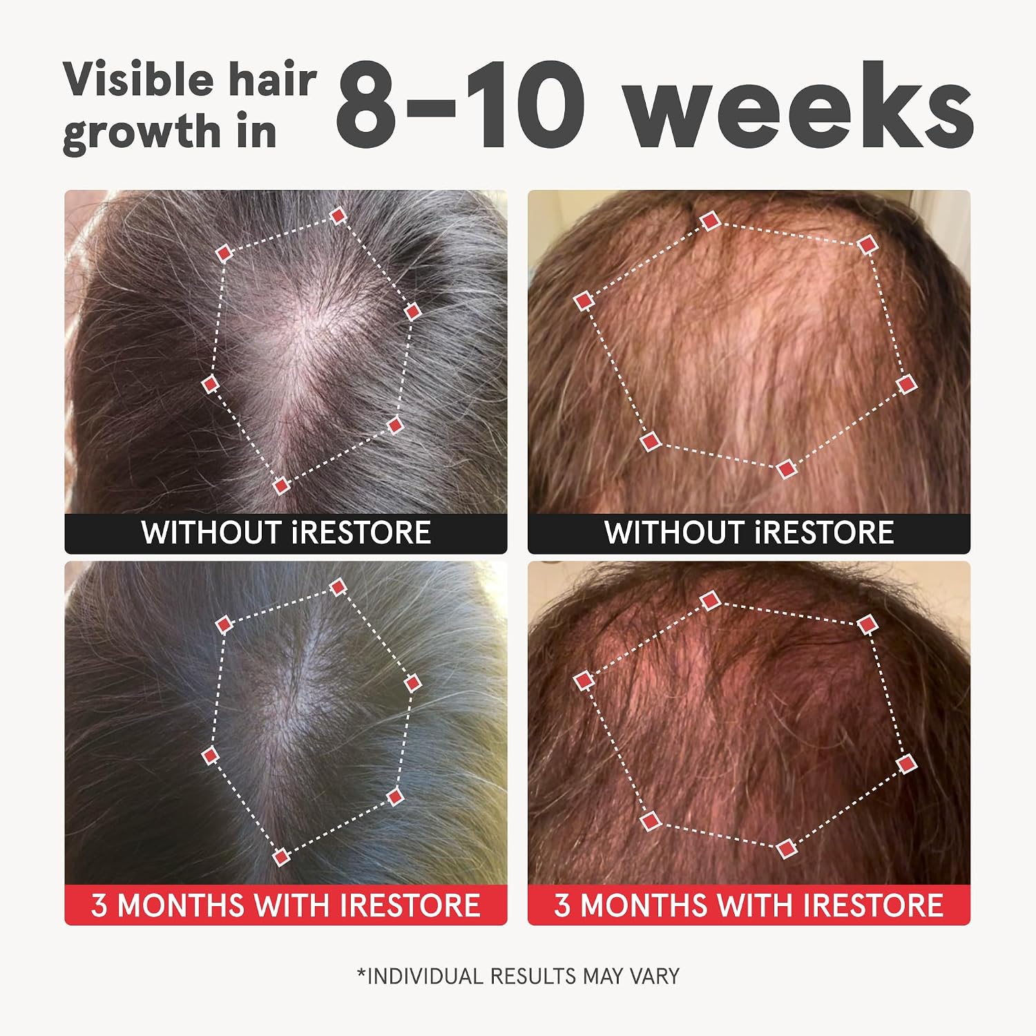 iRestore Advanced Hair Growth Supplement for Women with Lustriva
