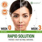 Perfect Skin Acne Pills - Suplemento Antiacné con Niacinamida, Probiótico, Zinc y Vitamina A - 60 Cápsulas