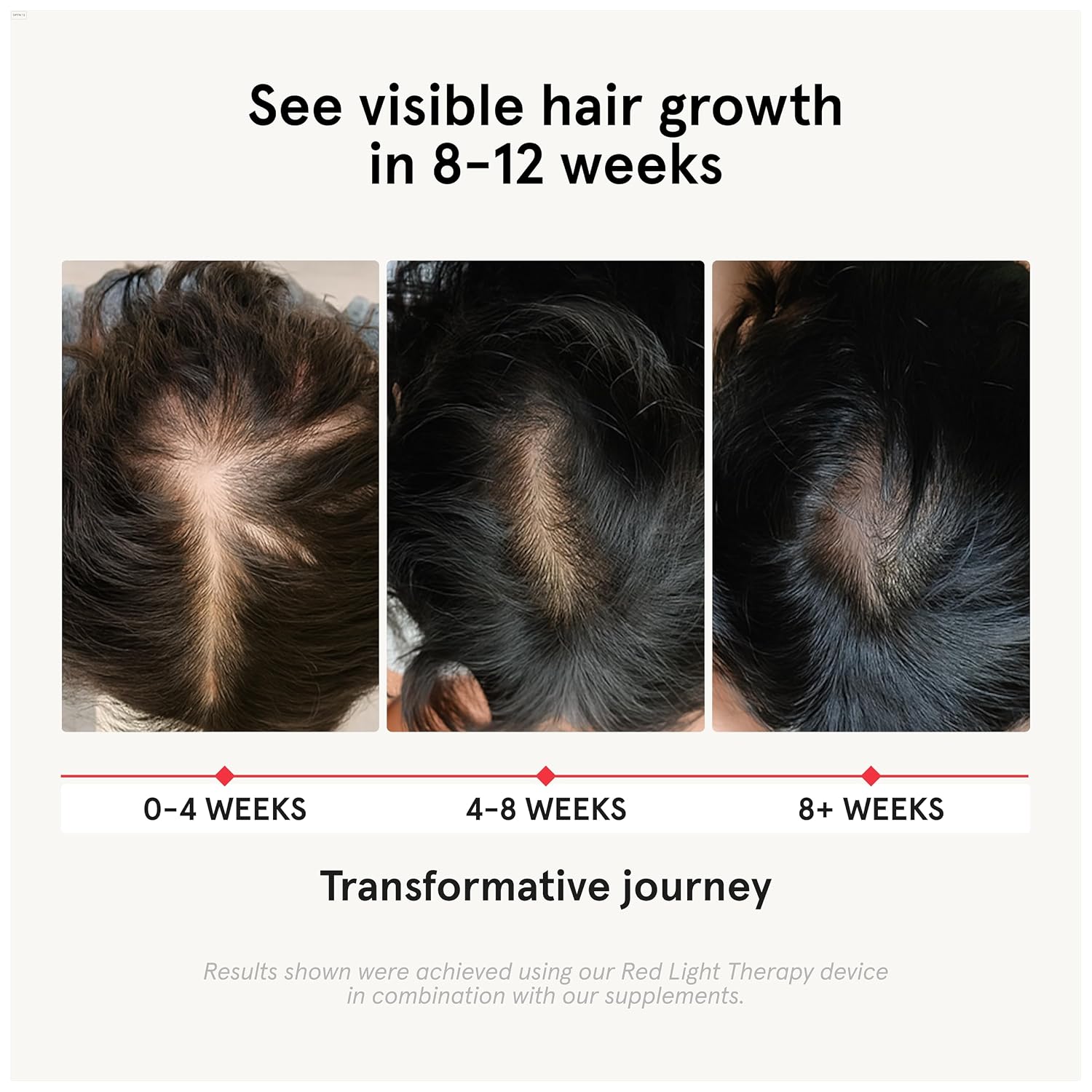 iRestore Suplemento de Crecimiento Capilar - Vitaminas para la Caída del Cabello para Mujeres y Hombres - Biotina y Bloqueador de DHT - 90 Cápsulas (30 Días)