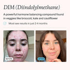 MDacne DIM con Extracto de Crucíferas y Bioperina - 30 Cápsulas Veganas
