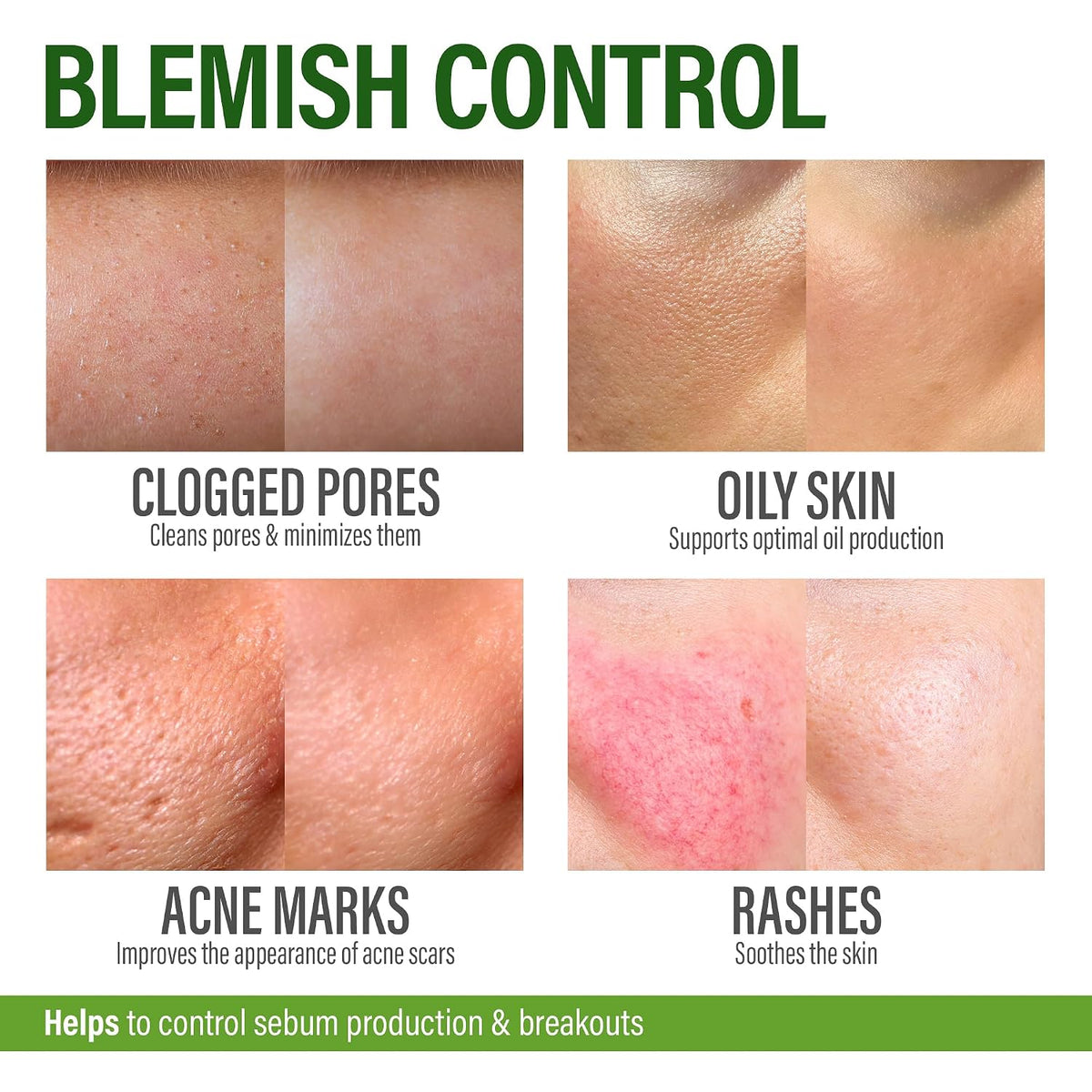 Perfect Skin Acne Pills - Suplemento para el – Biotina: contribuye al mantenimiento de la piel normal. – Image 4