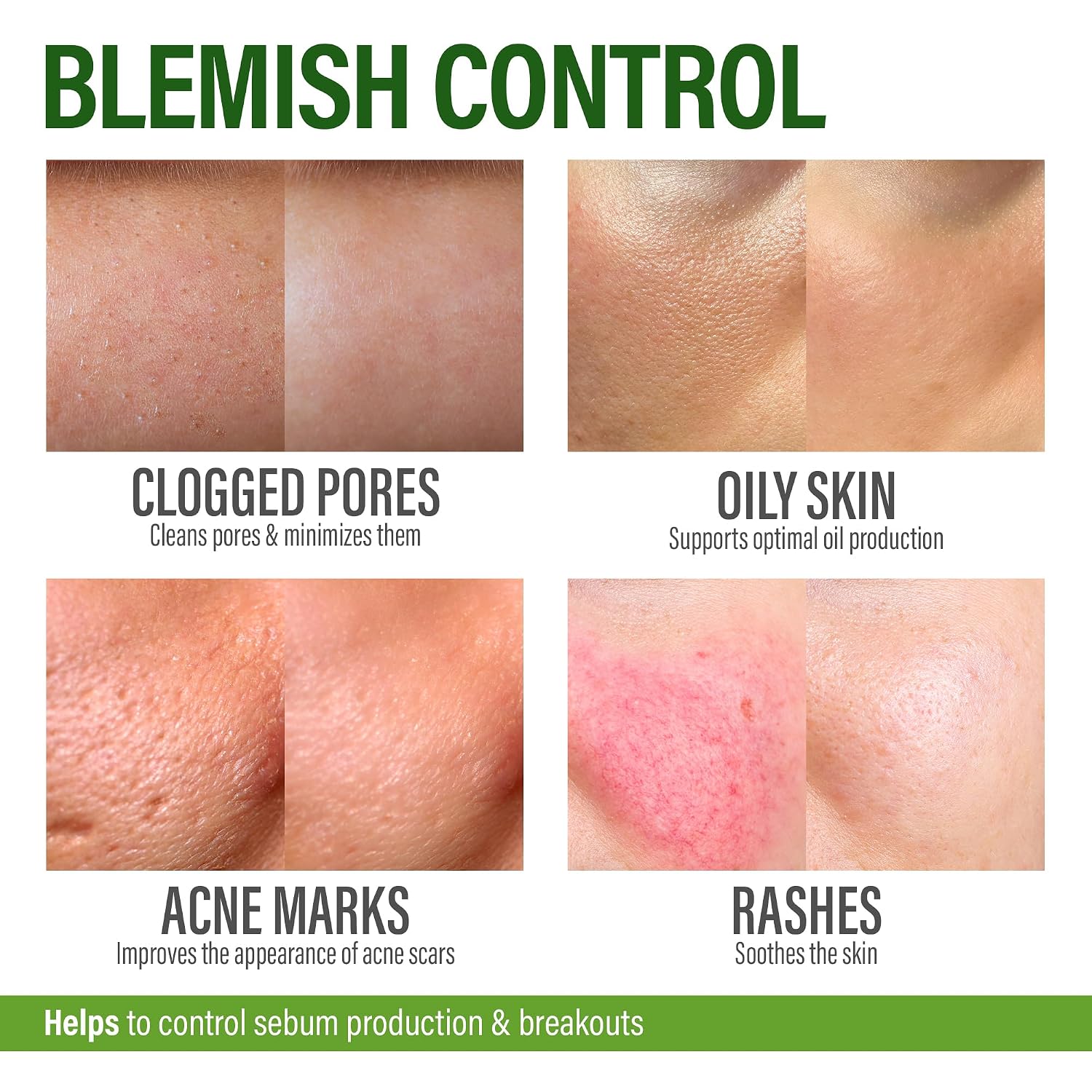 Perfect Skin Acne Pills - Suplemento para el Acné con Niacinamida, Probióticos y Zinc, 60 Cápsulas