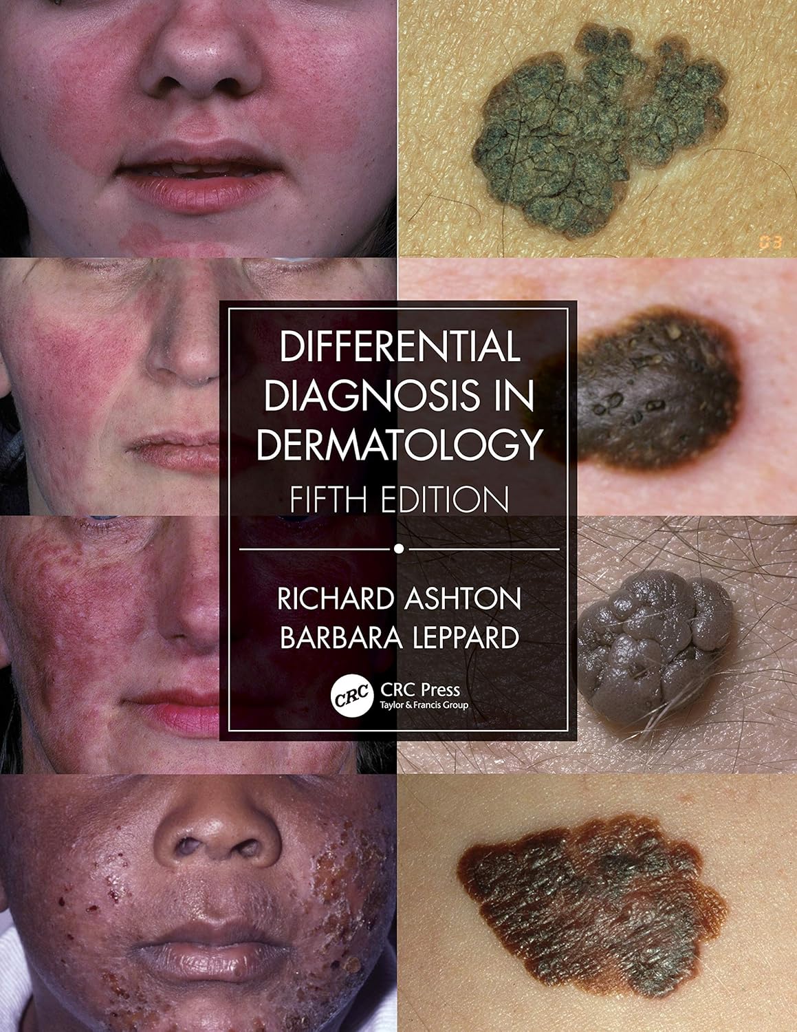 Diagnóstico diferencial en dermatología